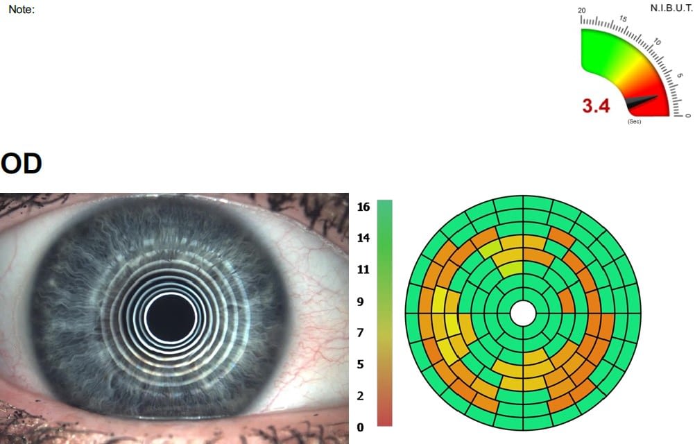 podgląd oka podczas badania czasu przerwania filmu łzowego