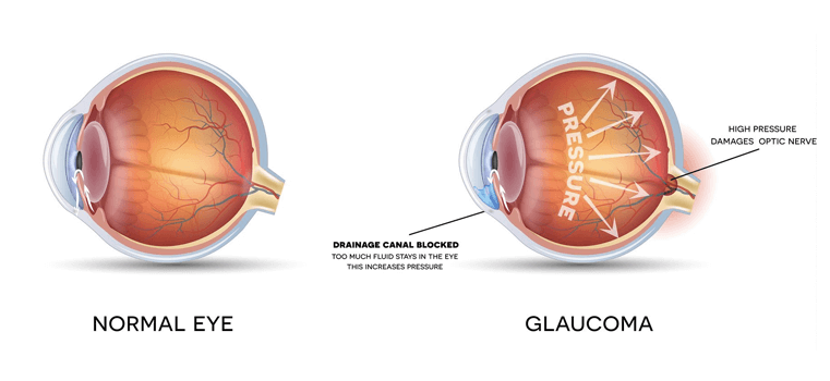 budowa oka: oko zdrowie i oko z jaskrą