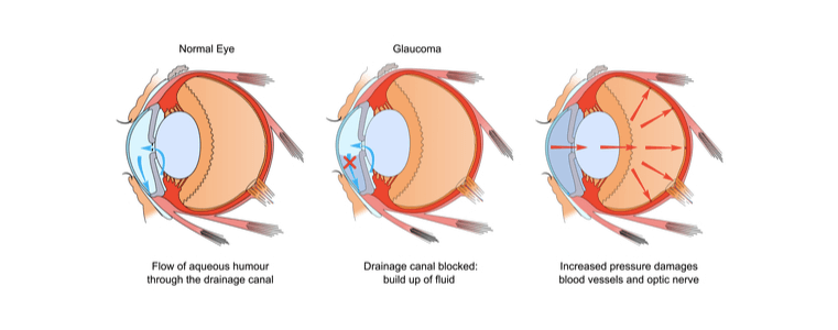 schemat obrazujący budowę oka i działanie jaskry