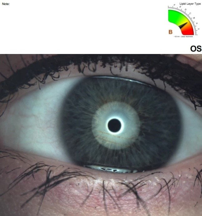 Podgląd oka podczas pomiaru grubości warstwy lipidowej. 